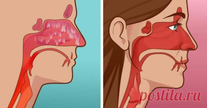 Як зупинити гайморит за 20 секунд? Закладений ніс є найпоширенішими симптомами гаймориту. Забитий ніс змушує вас відчувати себе слабким і хворим весь час. Як правило, гайморит триває від 10 днів до 8 тижнів, і якщо ви страждаєте від цього стану більше 8 тижнів, це стає досить серйозною проблемою. Ліки, які прописують при гаймориті мають такі побічні ефекти, як сонливість і погіршення […]