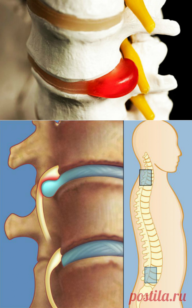 Грыжа позвоночника. Межпозвонковые грыжи. Спинная грыжа. Грыжа позвоночника без операции. Лечение позвоночной грыжи операция