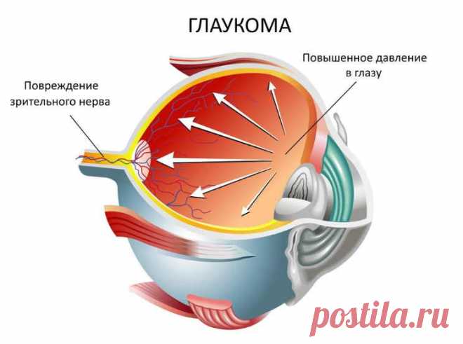 Глаукома — народные рецепты лечения коварного недуга. Будут глаза здоровы