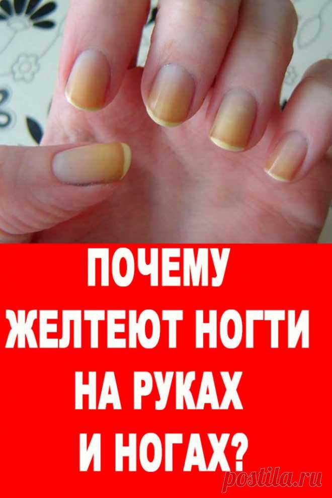 Почему желтеют ногти на руках и ногах? — Женские Советы