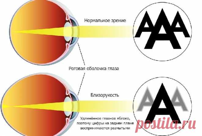 Как можно улучшить зрение при разной степени близорукости