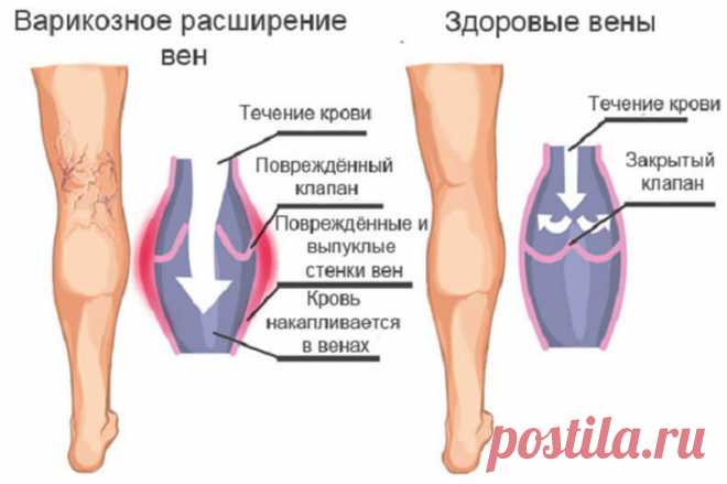 Чего боится варикоз: эффективные народные методы лечения