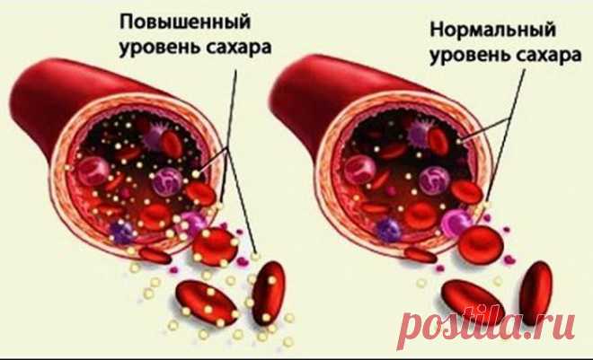 Чем можно снизить уровень сахара в крови