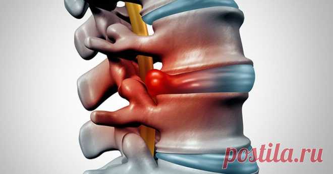 Как вылечить межпозвоночную грыжу при помощи физических упражнений