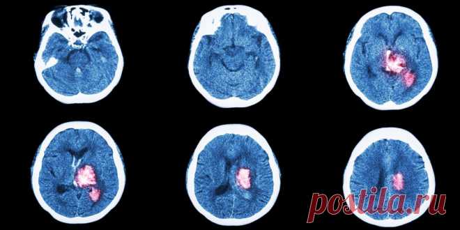 6 признаков инсульта, при которых нужно действовать как можно быстрее - МирТесен