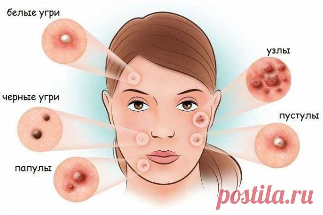 Эффективные и дешевые мази от прыщей . Милая Я Ничто так не портит внешность, как кожа, усыпанная прыщами. Даже самый красивый человек много теряет в привлекательности из-за несвежей воспаленной кожи. Но далеко не всегда для лечения угревой сыпи и точечных высыпаний нужно использовать очень дорогие косметические средства или обращаться к косметологу. Если ситуация еще не достигла клинической формы, справиться с дефектами кожи вполне помогут простые и недорогие аптечные маз...