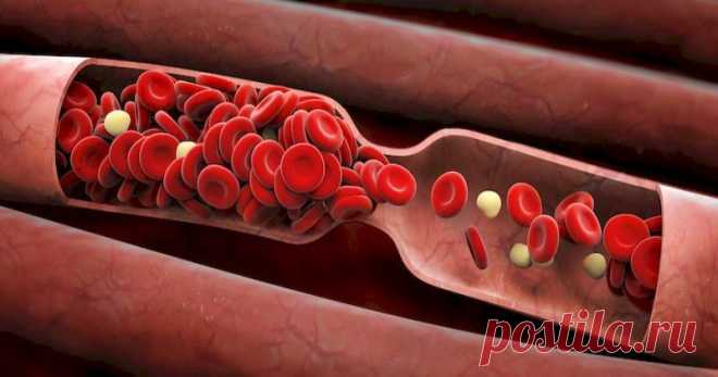 Тромб не подождет: 6 признаков, что в ваших жилах засел смертельно опасный сгусток крови Образование сгустков крови – важный физиологический процесс при травматических повреждениях. Но образование тромбоза глубоких вен приводит к серьезным последствиям и даже иногда к летальному исходу. С…