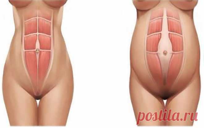 Диастаз прямых мышц живота: Кто виноват и что делать Сегодня статья на одну из самых востребованных женских тематик — диастаз прямых мышц живота после родов. Поэтому мужчины, если Вы заглянули к нам на огонек, то можете спокойно возвращаться к своим дел…