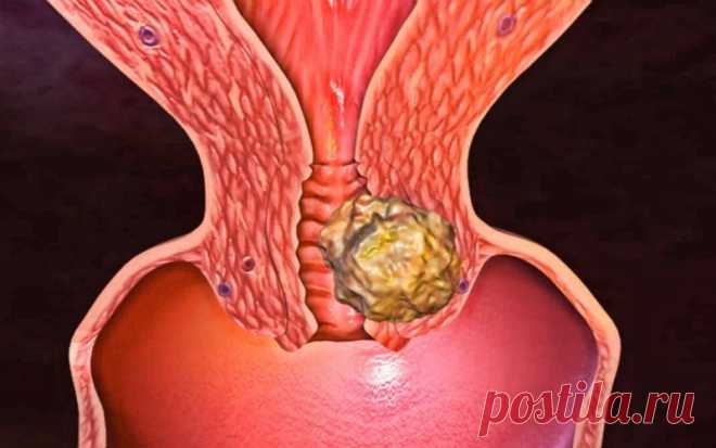 Вовремя заметить, чтобы спастись: главные признаки рака шейки матки