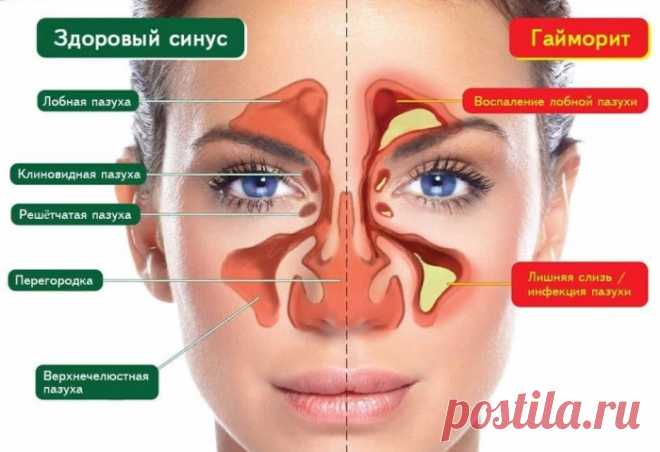 Советы при лечении гайморита.