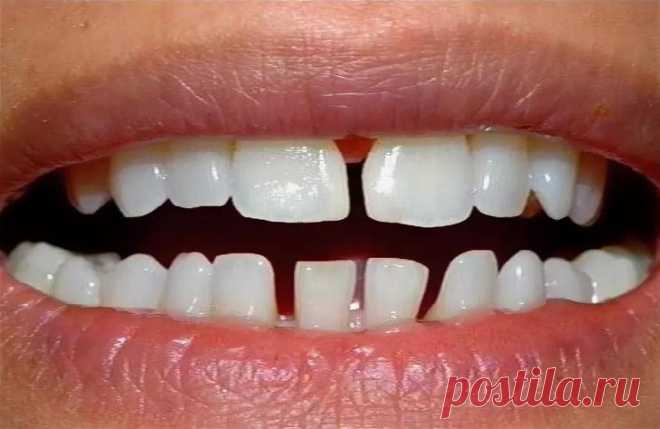Редкие зубы: причины, методы лечения