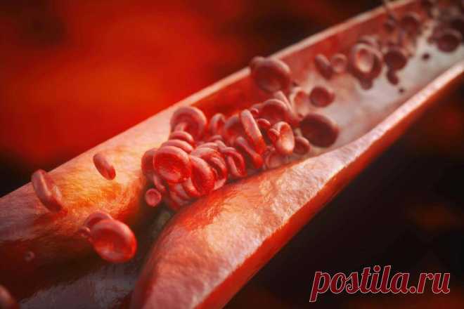 Признаки, которые с 100% точностью позволят распознать тромбы в сосудах
Тромб – это сгусток крови, который может образоваться в любой локации сосудистой системы. Тромб закупоривает сосуды, из-за чего кровоток по ним ухудшается – кровь в меньшем количестве поступает к органам и тканям, возникают дефицит питательных веществ и гипоксией (кислородным голоданием). Если тромб отрывается и мигрирует...
Читай дальше на сайте. Жми подробнее ➡