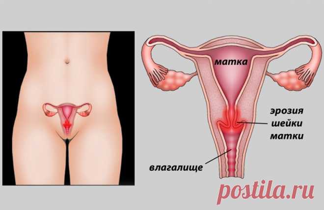 Каждая вторая женщина страдает от эрозии шейки матки! Пора разорвать этот заколдованный круг… 
Едва ли не каждая вторая женщина покидает кабинета гинеколога с диагнозом — эрозия шейки матки. Эта болезнь считается одной из частых патологий у женщин репродуктивного возраста. 
Нередко врачи в час…