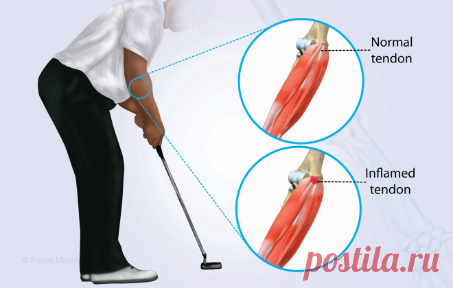 Because golfers are particularly prone to the ailment because of the nature of their activity, many people who participate in repetitive gripping or wrist flexion exercises suffer from golfer's elbow, also known as medial epicondylitis. Golfer's elbow discomfort must be managed and reduced using a multimodal approach since the pain and inflammation felt on the inside of the elbow can greatly interfere with day-to-day activities. This thorough guide examines the several methods of pain management