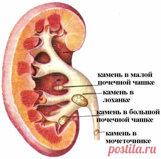 «Камни и песок в почках - симптомы и лечение. Откуда камни и песок в почках и мочевом пузыре, симптомы. Как очистить почки и мочевой пузырь от песка и камней. Методы лечения камней и песка в почках. Камни больших размеров удаляют хирургическим путем. Сюда же относится и литотрипсия дистанционная. С ее помощью дробят конкременты до мелких размеров. У процедуры есть свои нюансы, поскольку иногда страдают и органы от такого воздействия. Наиболее совре...