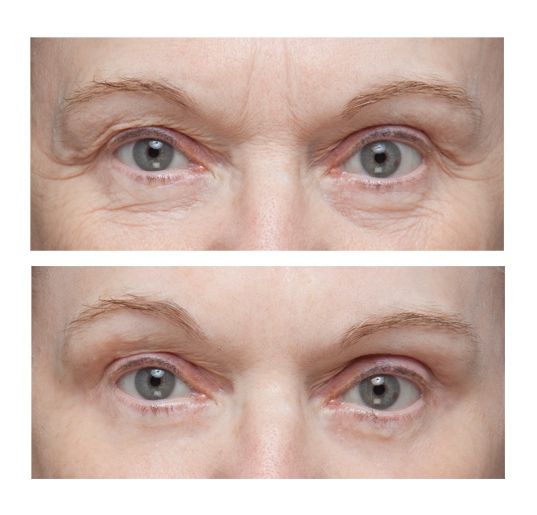 коррекция мимических морщин. морщинки вокруг глаз до и после. морщины до после. мезотерапия кожи вокруг глаз. морщины глаз отзывы.